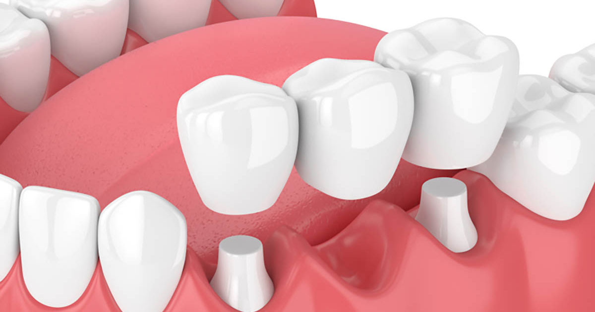 Dental Bridges