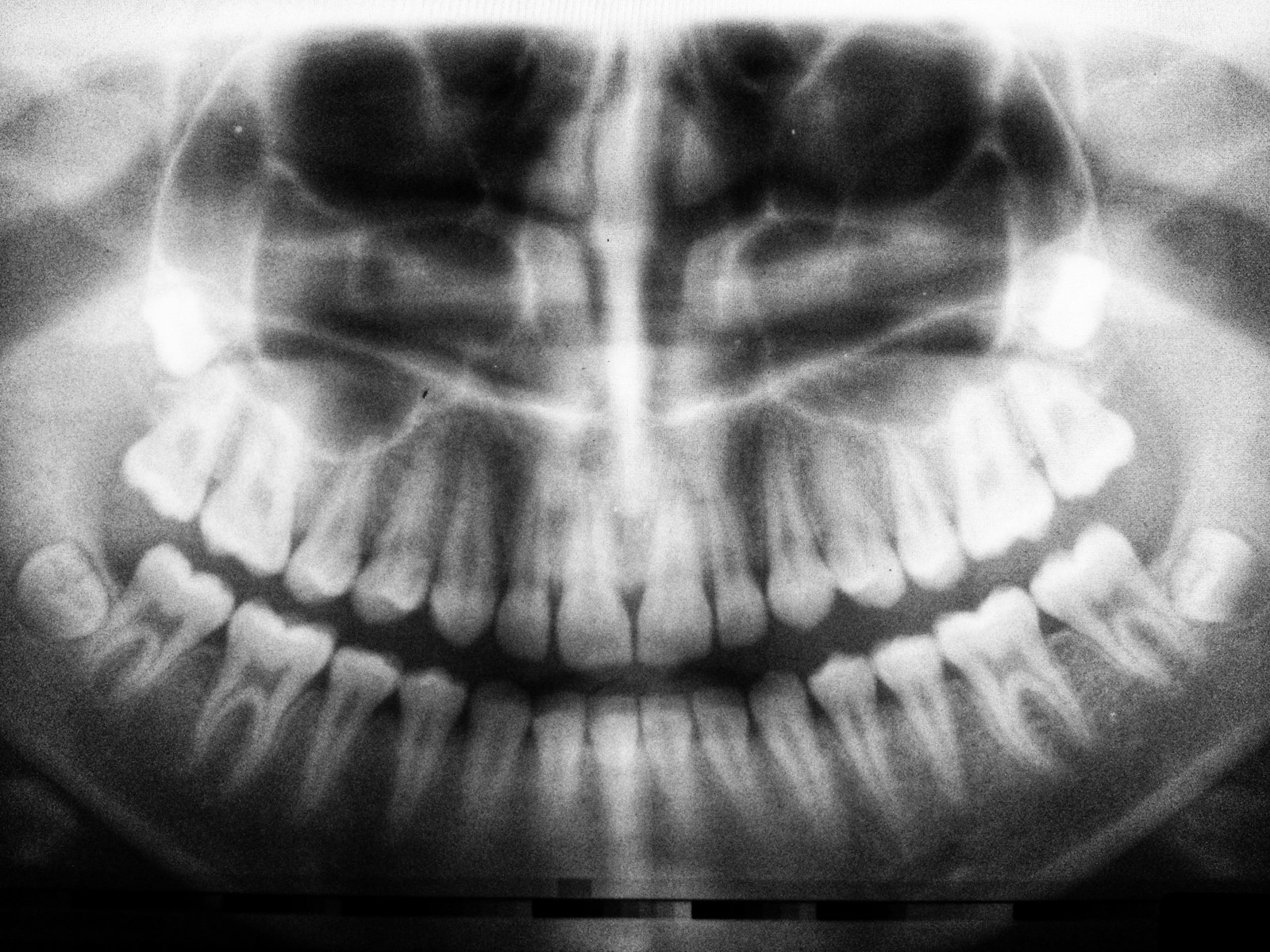 Digital X-Rays